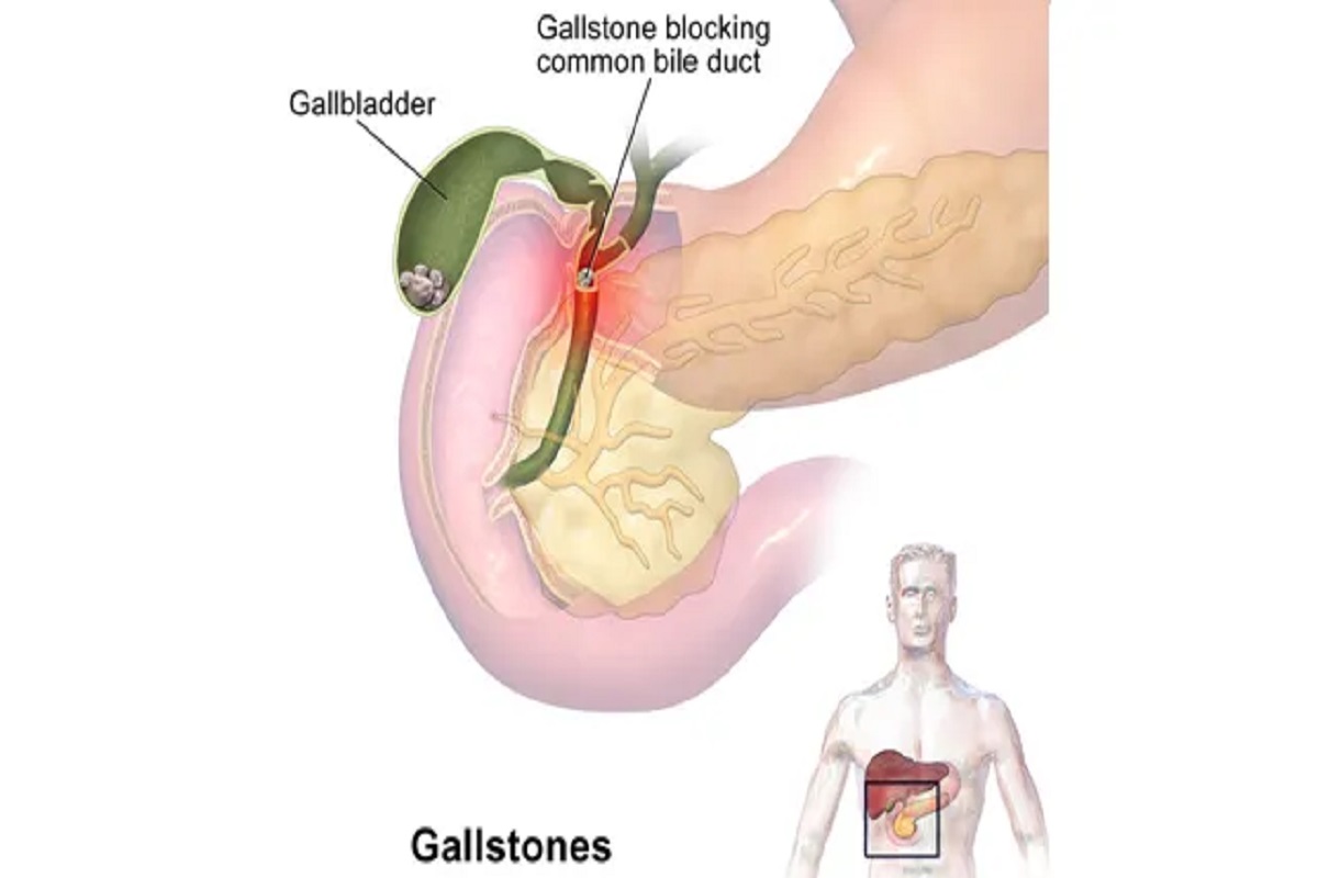 A Manual Guide To Gallstones