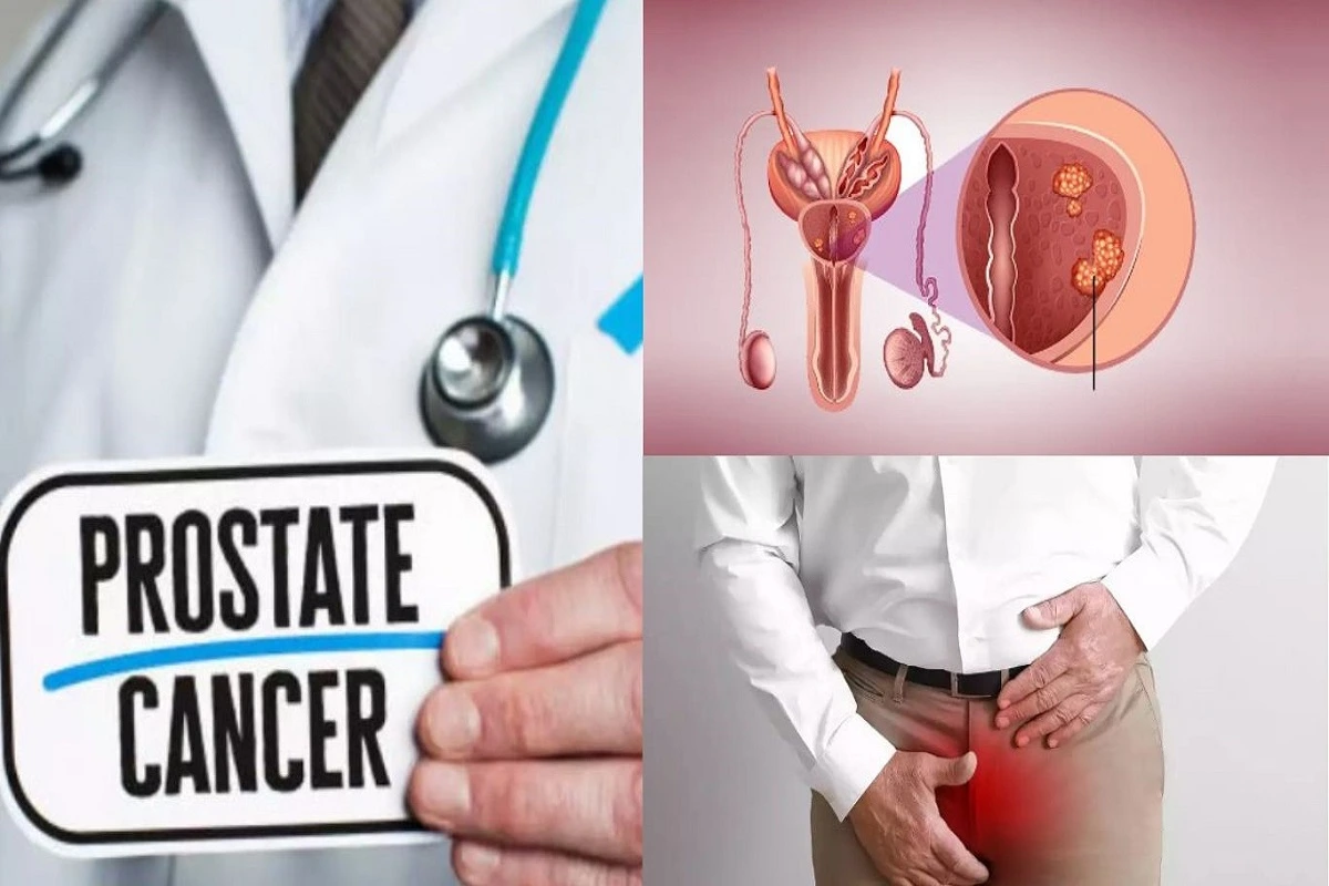 Can Men Diagnosed With Prostate Cancer Delay Their Treatment? Read Here What Experts Say…